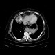 Chondroma of lung, gigantic: CT - Computed tomography